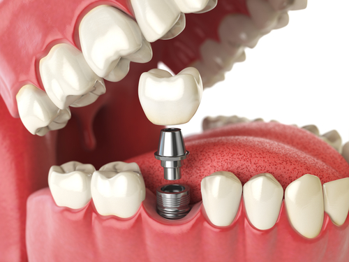 교정 전문 치과 - 치아교정 | 충치 신경치료 | 임플란트 | 사랑니