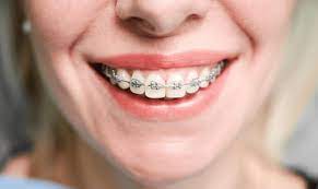Orthodontic Treatment Advantages and Disadvantages